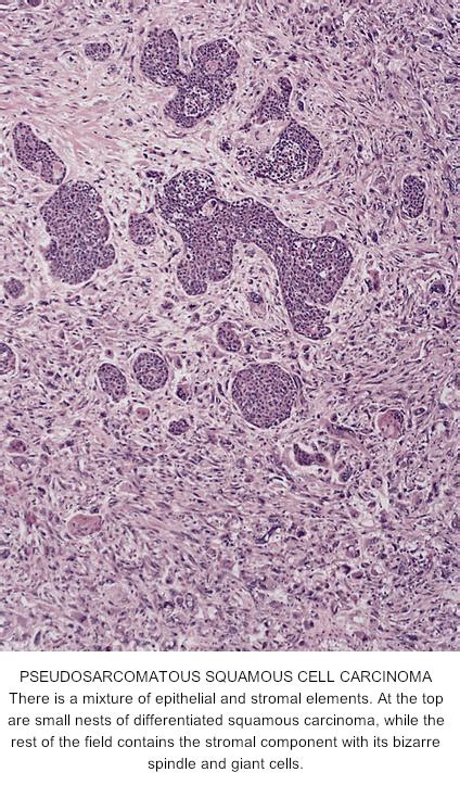 Pathology Outlines Spindle Cell Squamous Carcinoma