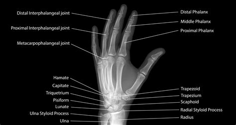 X -Ray Palm – e-CADAVIZ