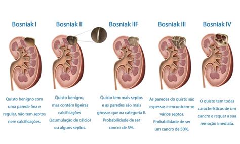 Quisto do Rim o que é tipos causas sintomas tratamento