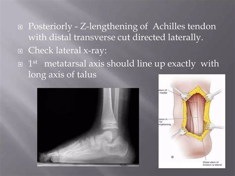 Congenital Vertical Talus Ppt