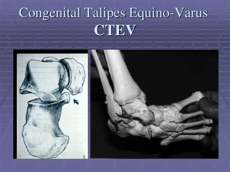 Ppt Congenital Talipes Equino Varus Congenital Clubfoot Powerpoint Presentation Id5730720