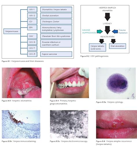 Dentistry and Medicine: Herpes Simplex Infections