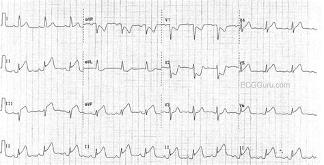 Inferior-lateral and Posterior Wall M.I. | ECG Guru - Instructor Resources