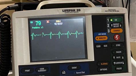 Diagnostic dilemma: Syncope vs. seizure