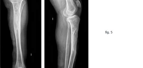 Tratamiento De La Osteomielitis De Tibia Somacot Sociedad