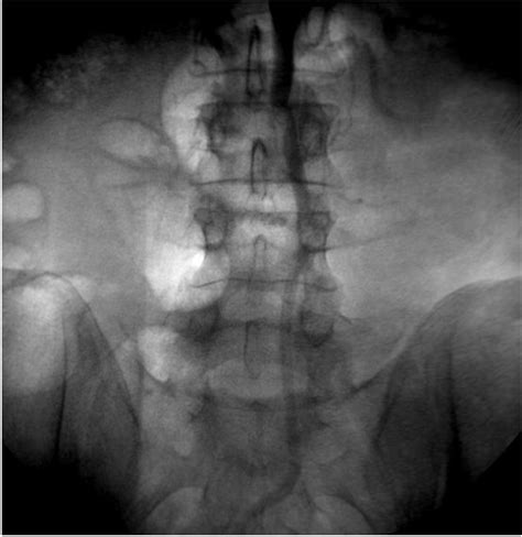 Leriche Syndrome: Percutaneous Treatment with Mechanical Thrombectomy ...