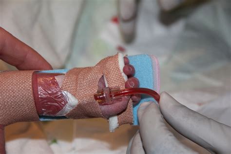 Peripheral Arterial Access In Neonates Requiring Intensive Care Safer