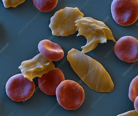 Sickle Cell Anaemia Sem Stock Image C058 0934 Science Photo Library