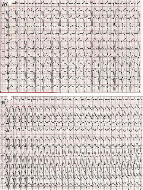 Dual Chamber Pacemaker Ecg