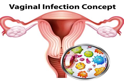 Vaginal Infection Treatment in Nagpur - Expert Care