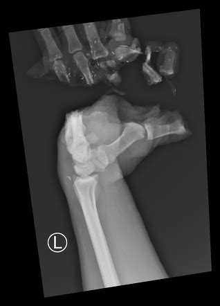 Traumatic Finger Amputation Radiology Case Radiopaedia Org