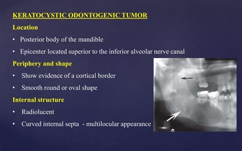 RADIOGRAPHIC FEATURES OF TUMORS OF JAWS PPT