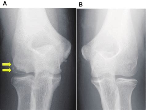 (A) Radiograph taken at the first examination showing an osteochondral... | Download Scientific ...