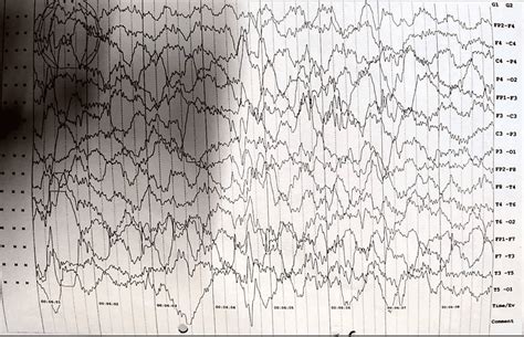 Interictal High Amplitude Waves And Spikes Seen In Eeg Suggestive Of