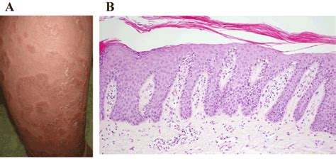 Erythema Gyratum Repens Histology