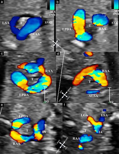 Prenatal Echocardiographic Assessment Of Right Aortic Arch Campanale