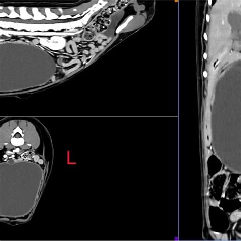 Multiplanar Reconstruction Of Post Contrast Abdominal Computed Download Scientific Diagram