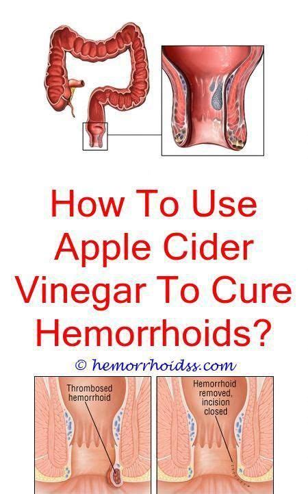 How To Do A Colon Cleanse Cure For Hemorrhoids Bleeding Hemorrhoids Hemorrhoids