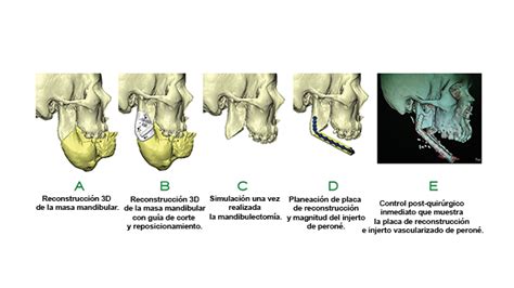 Reseccion Mandibular