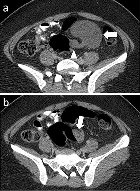 A 34 Year Old Woman With Left Ovarian Torsion A Axial Enhanced Ct