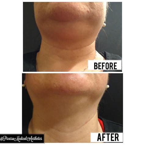 Botox Fillers Dermal Fillers Kybella Double Chin Sylvia Garcia