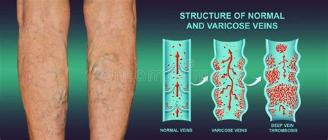 Deep Vein Thrombosis Or Blood Clots Embolus Stock Image Image Of