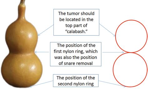 Schematic Diagram Of Endoscopic “calabash” Ligation And Resection To