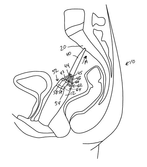 Vaginal Vault Suspension Device And Method Eureka Patsnap