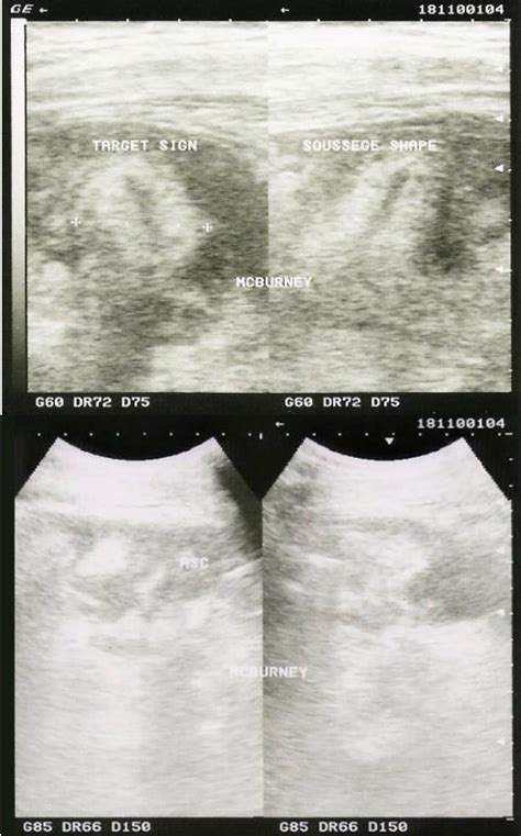 Figure From Appendicular Tuberculosis As Manifestation Of