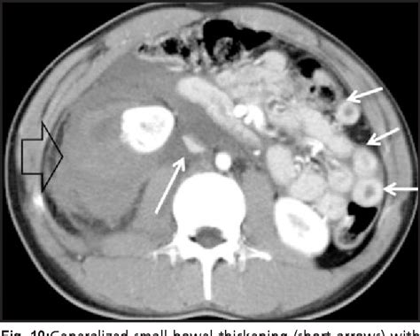 Figure 10 From Computed Tomography CT Of Bowel And Mesenteric Injury