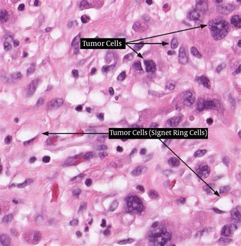 Signet Ring Histology