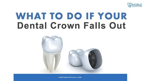 What To Do If Your Dental Crown Falls Out YouTube