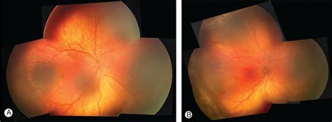 Retinopathy Of Prematurity Pathophysiology And Screening Clinical Tree