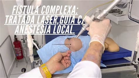 Fístula Cirurgia C Laser C Anestesia Local Sem Incontinência Anal