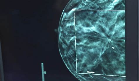 3d Tomosynthesis Better Detection At Andover Medical Center