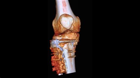 CT Scan 3D Of Right Knee 7th May 2013 4 5 Months After ORIF Surgery