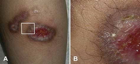 Hypertrichosis Around A Leg Ulcer Being Treated With Prostaglandin E1 Ointment Journal Of The