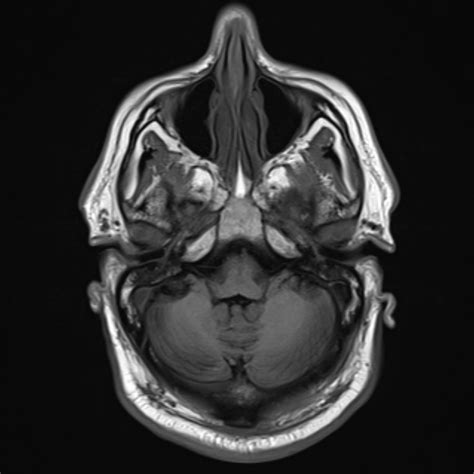 Cholesteatoma Image