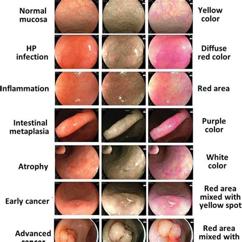 Typical Endoscopic Images For Normal Mucosa Hp Infection