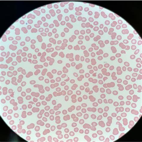 Peripheral blood smear on presentation showing many schistocytes ...