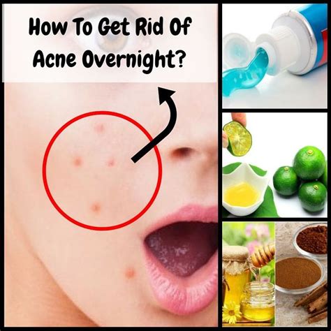 Here Are The Natural And Powerful Ways Of Getting Rid Of An Acne Overnight Check It Out How