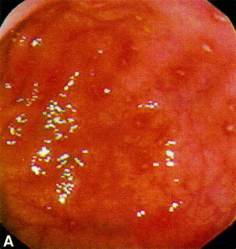 Colonic Mucosal Abnormalities Associated With Oral Sodium Phosphate Solution Gastrointestinal