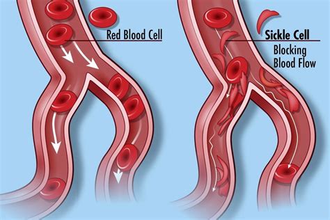 Sickle Cell Anemia Diagram | Quizlet