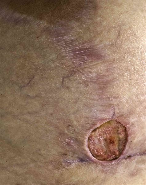 Sebaceous Cyst Bikini Line