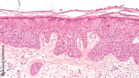 Cancer Of Sun Damaged Skin In Squamous Cell Carcinoma In Situ Bowen