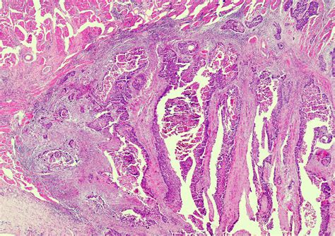 Cornification Of Squamous Cancerous Bild Kaufen Science