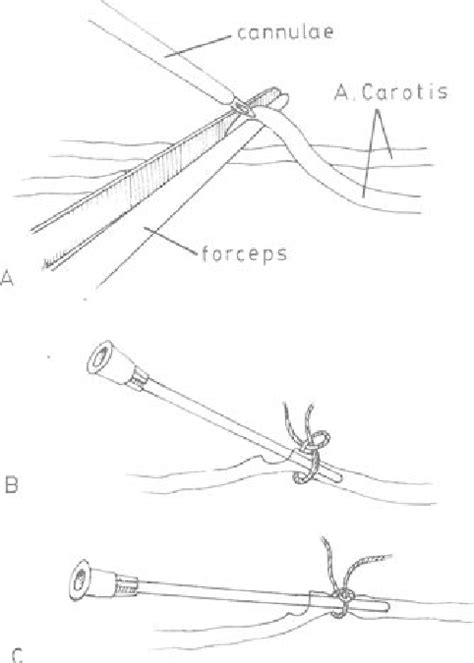 cannulation   vessel  scientific diagram