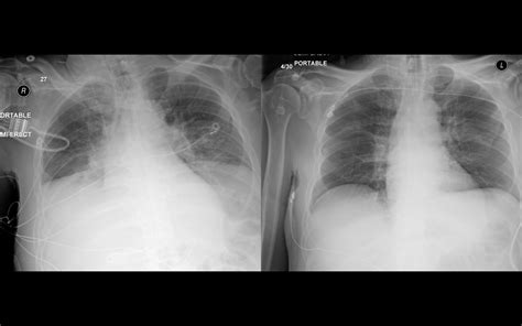 How To Assess Cxr Image Quality — Radiology Slides