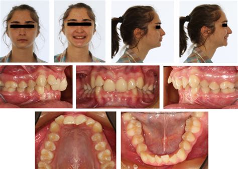 Class Ii Malocclusion Treatment Adults Good Piece Chronicle Photo Exhibition