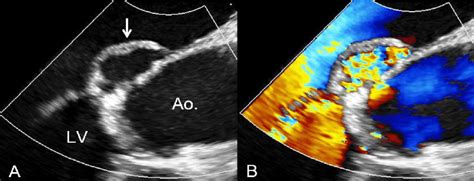 Preoperative Transesophageal Echocardiography White Arrow Indicates An Download Scientific